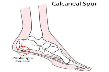 heel spur
