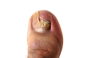 toenail fungus